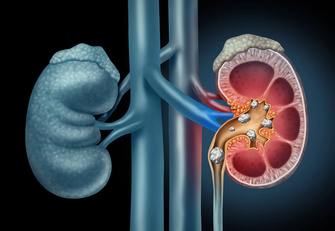 How to Remove Kidney Stones without Surgery