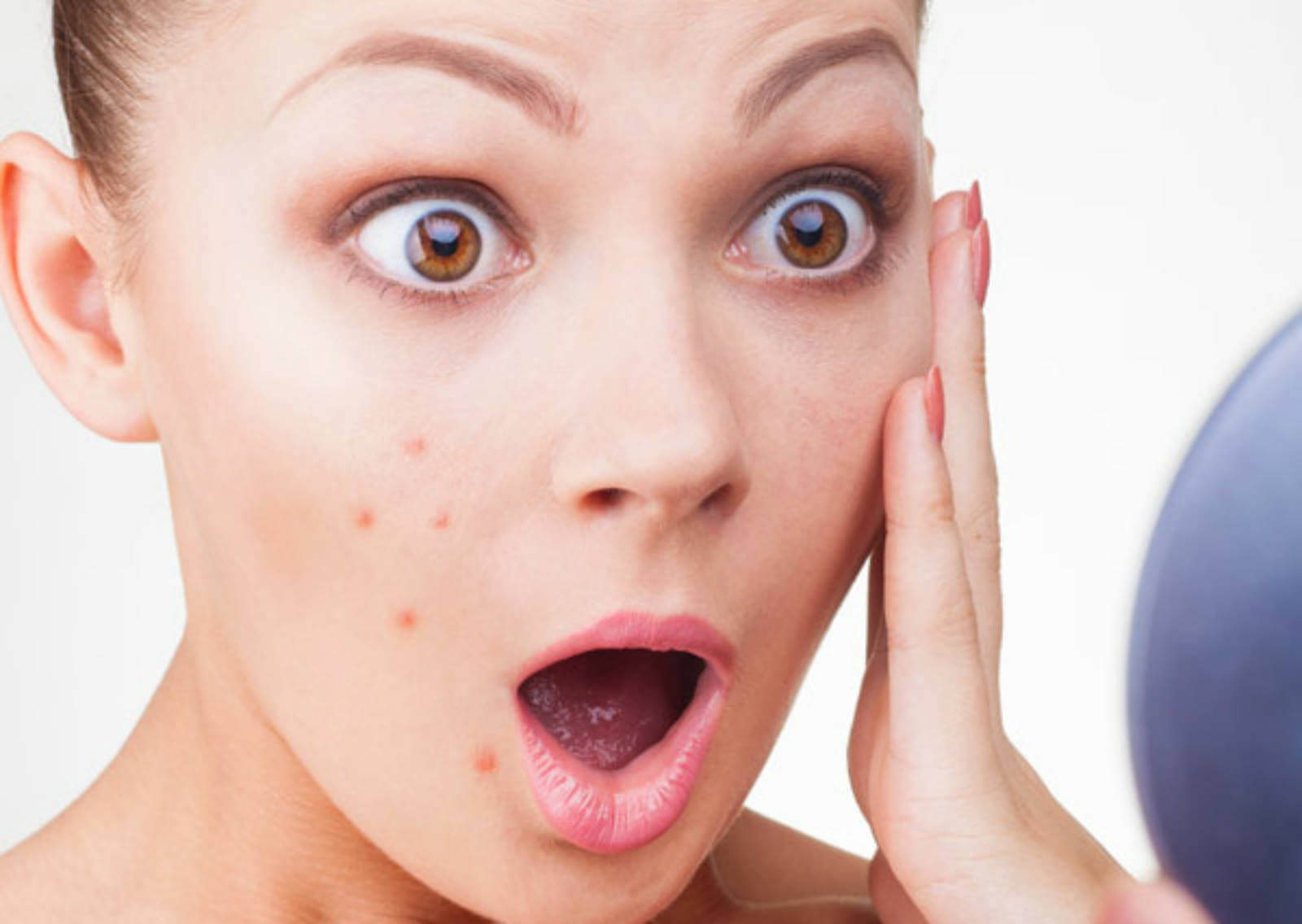 Home Remedies for Pimples or ACNE
