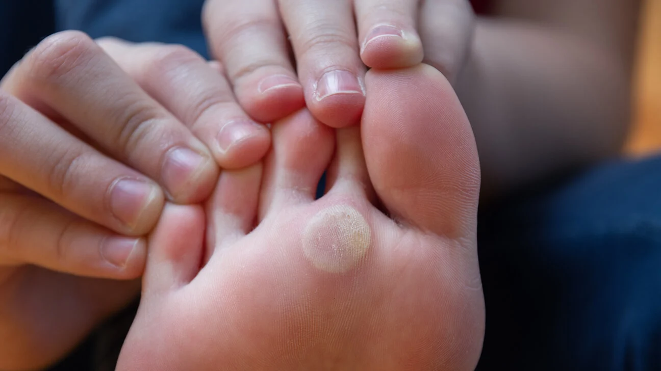 Treating and Preventing Foot Corns Treating and Preventing Foot Corns