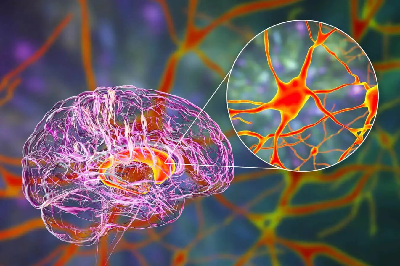 What is Huntington's Disease - A Comprehensive Overview for New Diagnoses